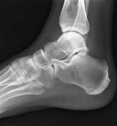 Foot and Ankle X-Ray